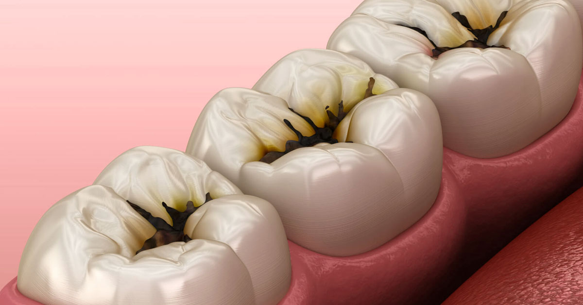 how to prevent cavities tooth decay