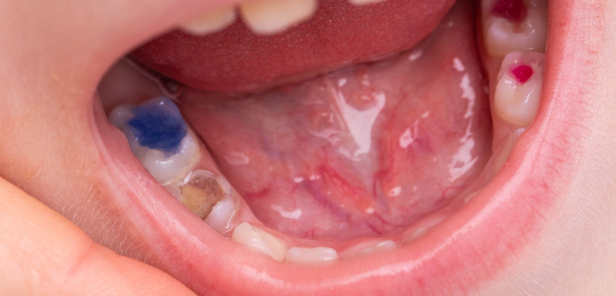 Benefits Of Tooth-Colored Fillings