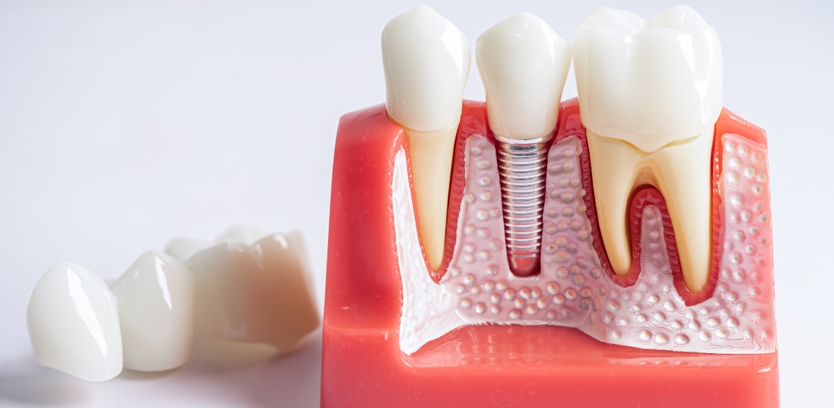 Do Root Canals Trigger Chronic Health Issues