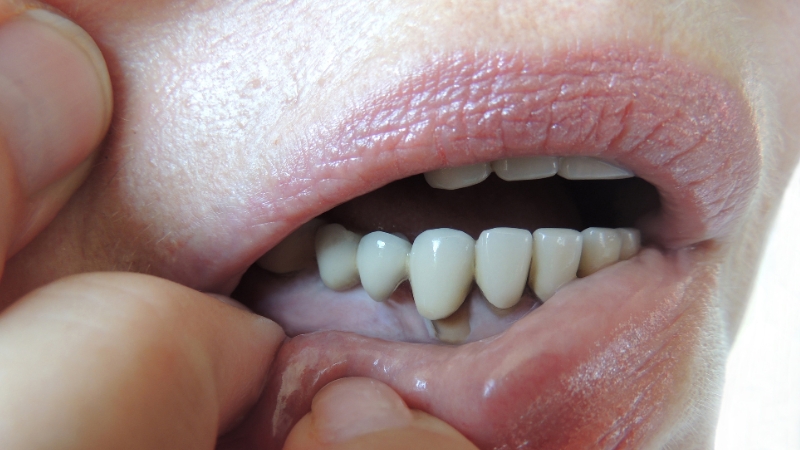 7 tips for reversing periodontitis