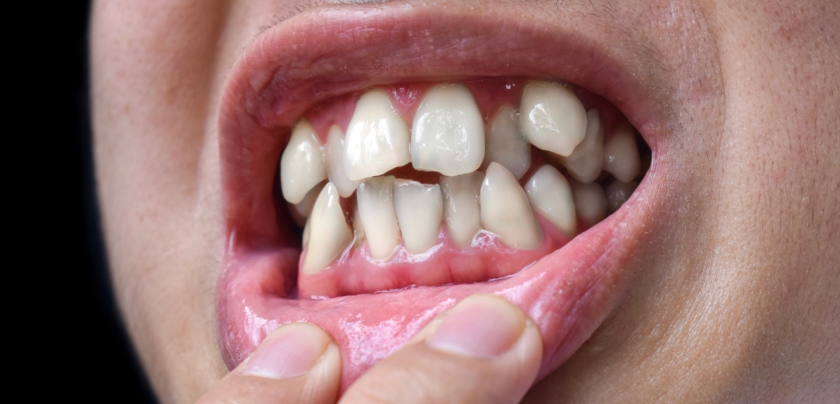 can a cosmetic dentist fix your crooked teeth
