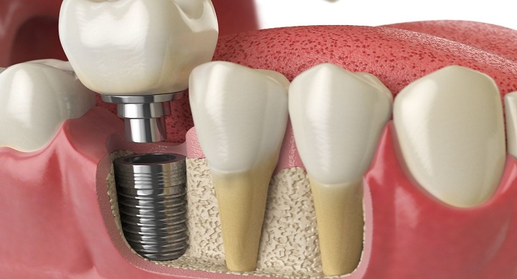 After Tooth Loss with Dental Implants in Brentwood